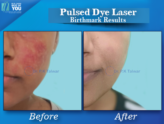 Pulsed Dye Laser Result